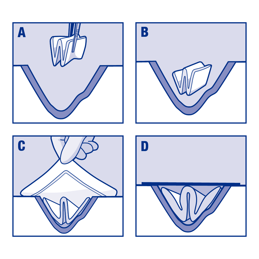 Afbeelding die laat zien hoe Cutimed® Cavity moet worden aangebracht. Afbeelding die laat zien hoe Cutimed® Cavity moet worden aangebracht.